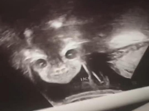 Aterradoras imágenes captadas en ultrasonido