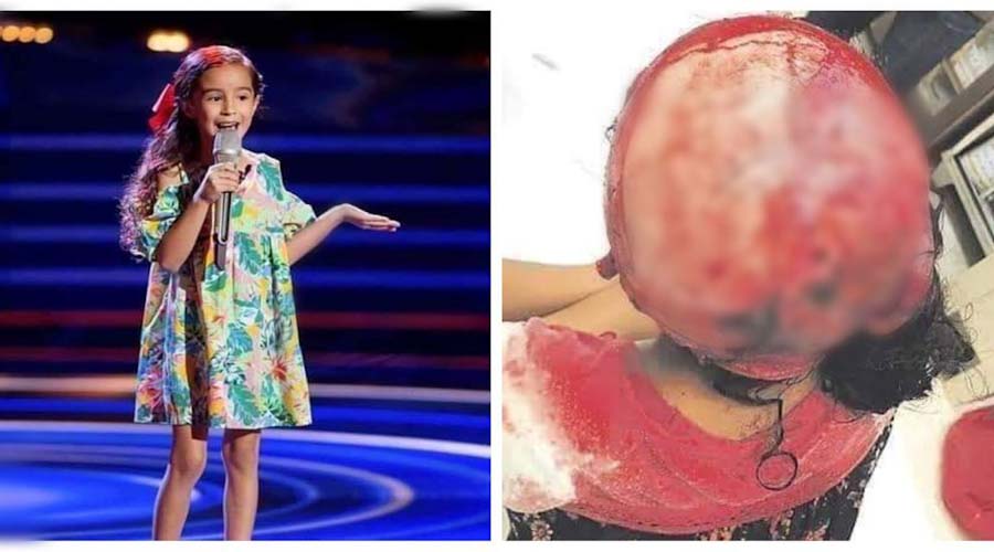 Marian de la Voz Kids sufre accidente en juego mecánico que le arranca el cuero cabelludo