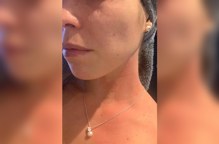 Agredida con cloro por salir a pasear a su perro