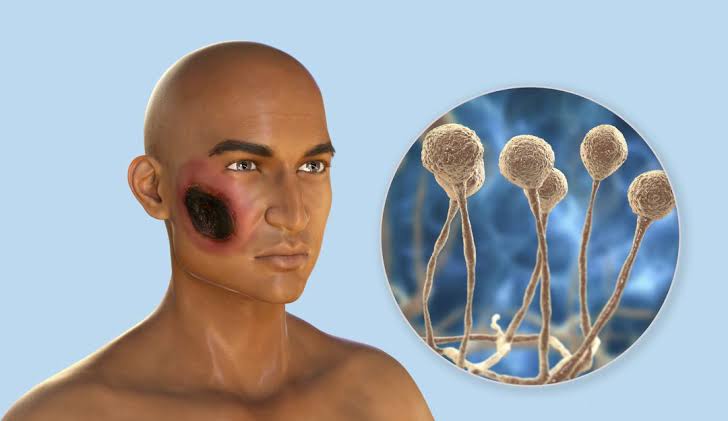 Hay dos casos sospechosos de hongo negro en Oaxaca; uno falleció