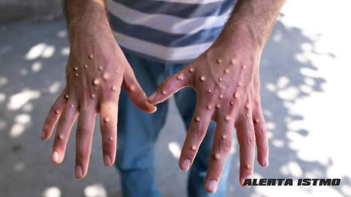 ¡ALERTA! Migrante nicaragüense con posible Viruela de Mono llega a Tapanatepec, Oaxaca